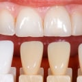 How Porcelain Veneers are Crafted