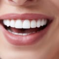 How Much Does it Cost to Get Porcelain Veneers?