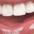 Are Porcelain Veneers Safe? A Comprehensive Guide