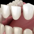 What are Porcelain Veneers and How Can They Improve Your Smile?
