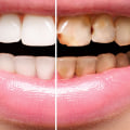 How Long Do Porcelain Veneers Last?