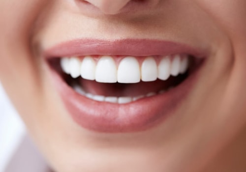 How Much Does it Cost to Get Porcelain Veneers?