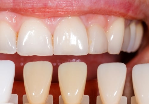 What Do Porcelain Veneers Feel Like?