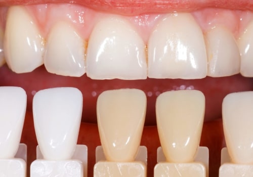 How Porcelain Veneers are Crafted