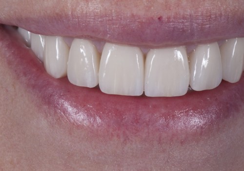 Are Porcelain Veneers False Teeth? A Comprehensive Guide