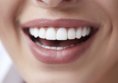 Is Porcelain Veneers Better Than Composite Veneers?